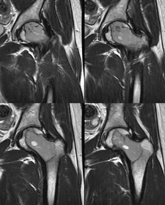 Figure 2 for case Clear cell chondrosarcoma ( RID4142 )